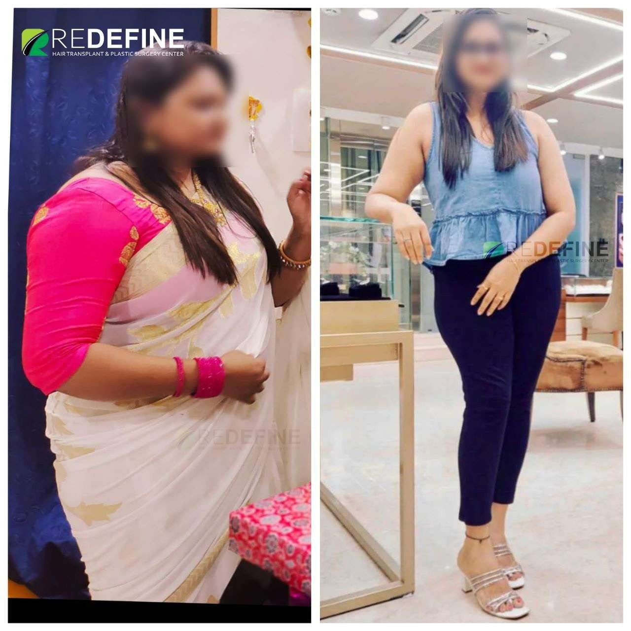 before after bariatric surgery