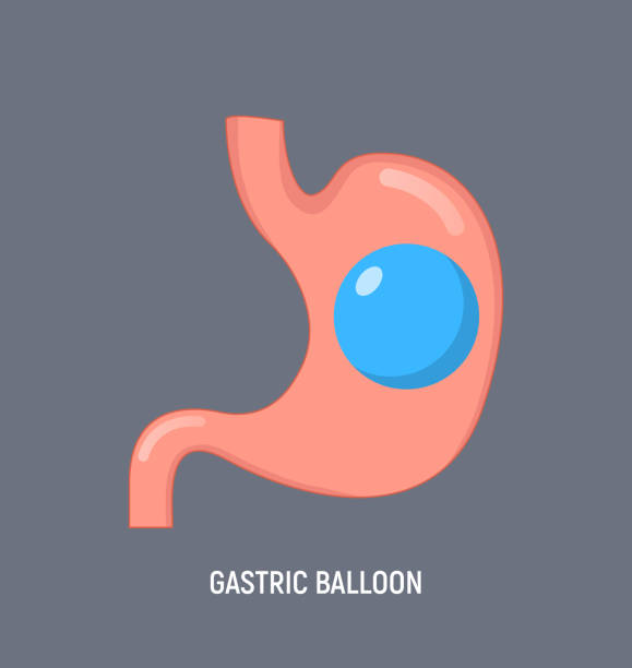 Gastric Balloon Placement