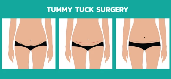  Tummy Tuck (Abdominoplasty): 