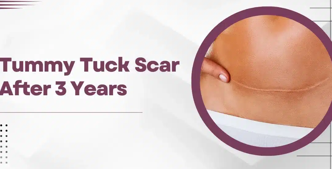 Overview of Tummy Tuck Scars after 3 Years