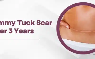 Overview of Tummy Tuck Scars after 3 Years