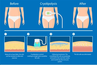 CoolSculpting Process