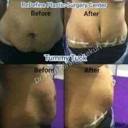 tummy tuck