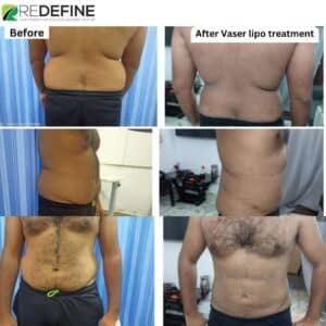 liposuction