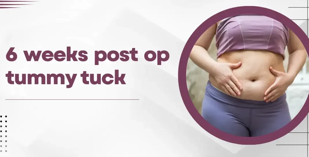 6 Week Post Op Tummy Tuck: What to Expect?