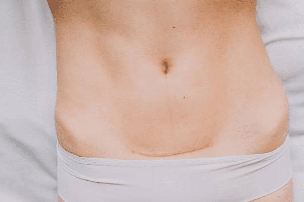 Lipo after Tummy Tuck - Safety and Timing