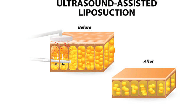 Ultrasound-Assisted Liposuction (VaserLipo)