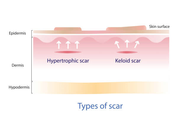 Causes of Arm Lift Scars After 1 Year